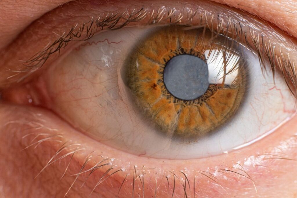 Navigating the Spectrum of Glaucoma: From Symptoms to Solutions